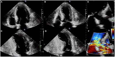 Cardiovascular Imaging in Stress Cardiomyopathy (Takotsubo Syndrome)